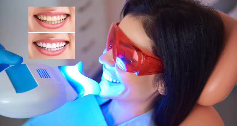 Why Is Zoom Teeth Whitening A Well-Liked Cosmetic Dental Procedure?